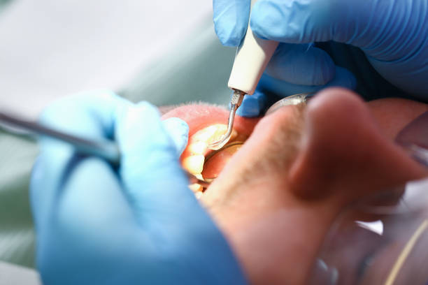 Best Emergency Wisdom Teeth Removal in Springs, NY